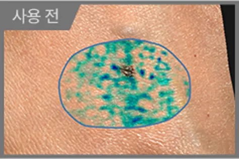 사용 전 피부 각질